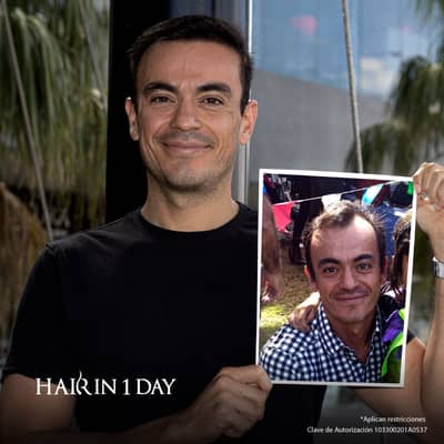 Slider image (1) Hair in 1 Day - Hair Transplant Clinic in Guadalajara